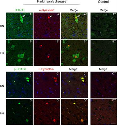 Phospho-HDAC6 Gathers Into Protein Aggregates in Parkinson’s Disease and Atypical Parkinsonisms